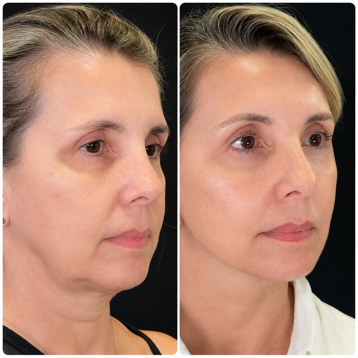Antes e depois